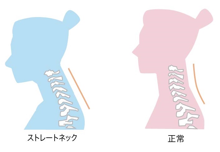 ストレートネックと正常な頚椎
