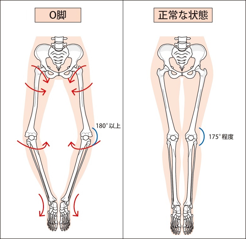 O脚・X脚の原因と改善方法。h&h八王子ユーロードの鍼灸整骨院・整体院