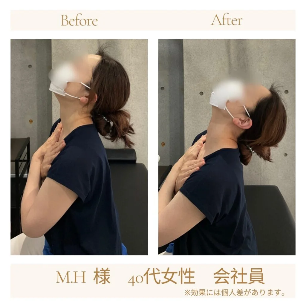 M.H様の施術前後の変化（側面・頭と肩の位置）